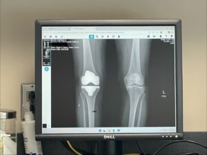 My knee replacement x-ray